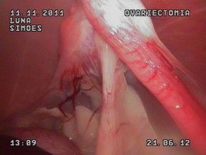 Cirurgia Laparoscópica